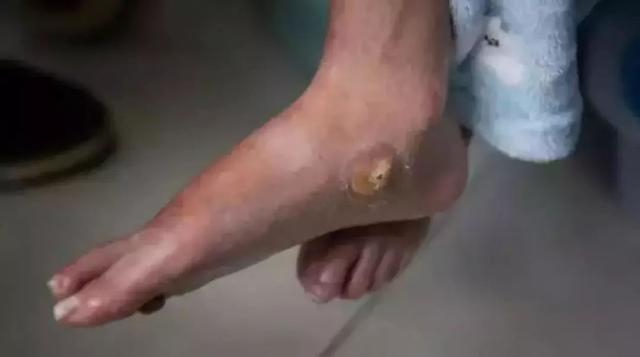 为了省钱救弟弟，姐姐吃5年糟辣椒拌饭，饿得只剩43斤