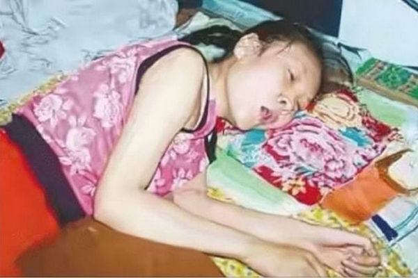 缩略图 | 骨灰级“躺平”：35岁懒惰女装瘫痪，竟一躺就是20年！