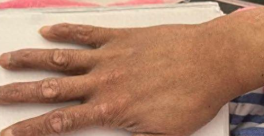缩略图 | 35岁女子“砒霜”中毒！竟然是吃了这款华人常用药！