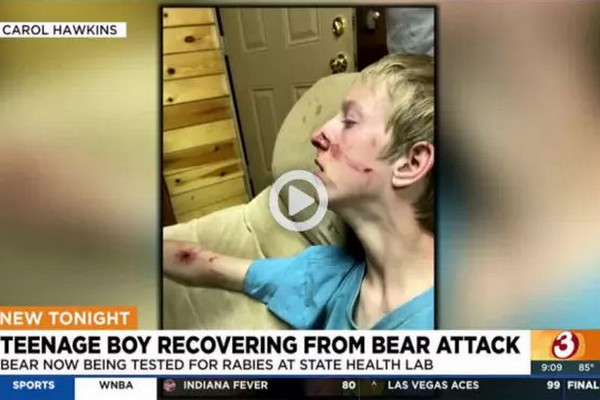 缩略图 | 15岁少年小木屋度假，被黑熊袭击受伤！
